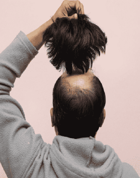 Best Hair Patch Clinic in Rajendra Place