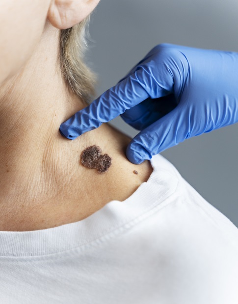 Wart/Skin tag Removal Clinic in Rajendra Place